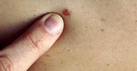 5 علامات بـ الشامة تكشف خلوك من الإصابة بسرطان الجلد