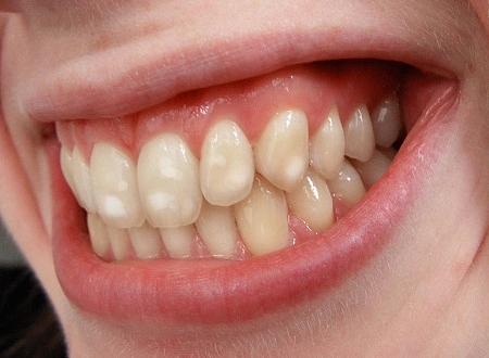 مما تظهر البقع البيضاء المزعجة على الأسنان؟