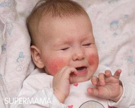 7 نصائح لعلاج جفاف قشف خدود الرضع