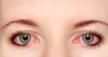 أسباب آلام العين أبرزها الصداع النصفى والجيوب الأنفية