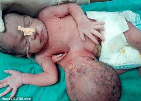 ولادة طفلة برأسين في الهند