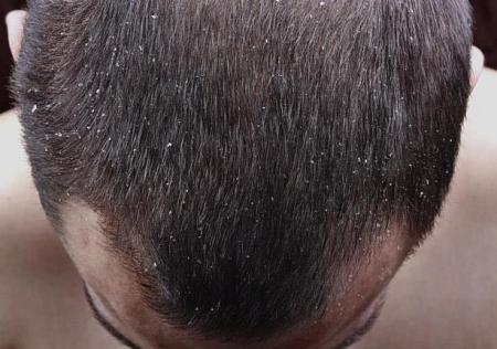 تركيبة بسيطة لعلاج قشرة الشعر وهذه تكلفتها صورة