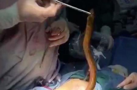 استخراج ثعبان من جسم مريض في الصين.. كيف دخل؟ (فيديو)