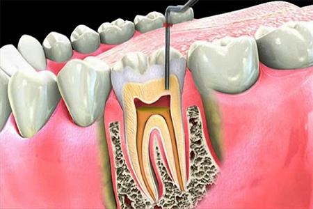 ما لم يخبركم به أطباء الأسنان عن خطورة فتح الأسنان والأضراس والأمراض القاتلة التي تنتج عنها 