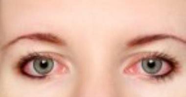 أخصائى عيون الماء البارد أفضل علاج لحساسية العين الناتجة عن حرارة الجو