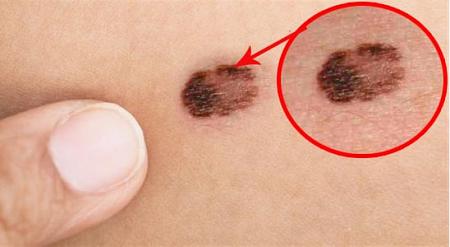 صور أنواع سرطان الجلد وكيف تميز الخطيرة منها والتي تظهر على جسم الإنسان وكيفية الوقاية منها