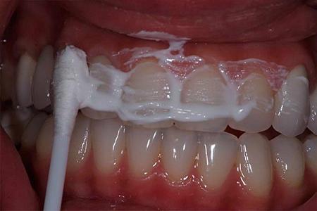 4 خطوات ينصح بها طبيب الأسنان لإزالة الرّواسب والتهاب اللثّة وتبييض الأسنان 