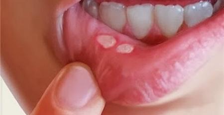 مرض قرحة الفم يأكل وجه الأطفال الفقراء