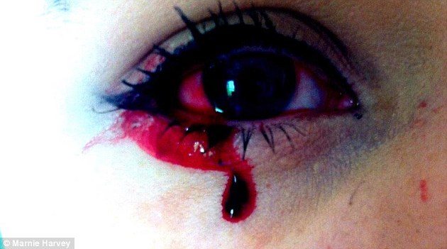 بكاء الدم حالة غريبة تصيب فتاة في ال 17 من عمرها