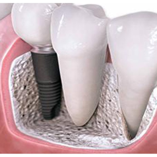 4 شروط يجب توافرها قبل عملية زراعة الأسنان