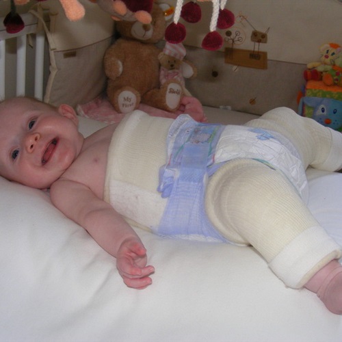 4 أسباب تؤدي إلى إصابة الأطفال بخلع مفصل الفخذ