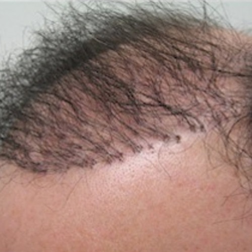 3 أضرار صحية تسببها عملية زراعة الشعر الصناعي اكتشفيها