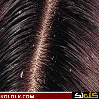 طرق ووسائل إزالة القشرة من الشعر