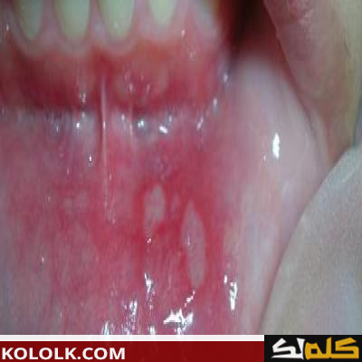 ما هو سبب الفطريات في الفم