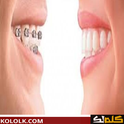 طريقة ازالة تقويم الاسنان