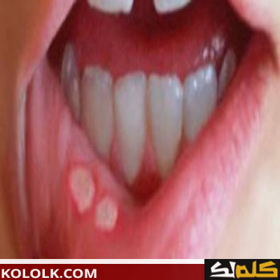 علاج و دواء تقرحات الفم