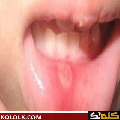 ما هى اسباب فطريات الفم
