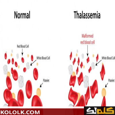 مرض الثلاسيميا