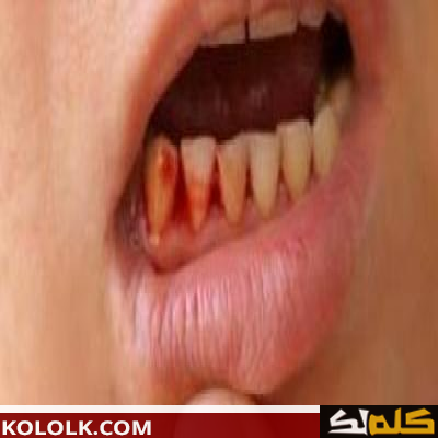 ما هى اسباب خروج الدم من الفم