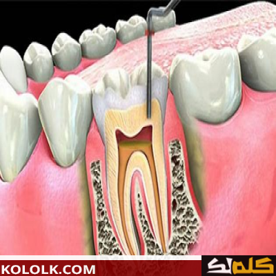 علاج و دواء التهاب عصب الأسنان