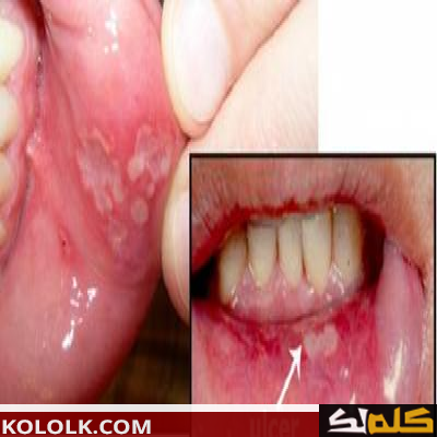طريقة علاج و دواء قرحة الفم