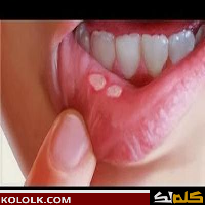 فطريات الفم عند الأطفال وعلاجها