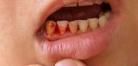 ما هى اسباب خروج الدم من الفم