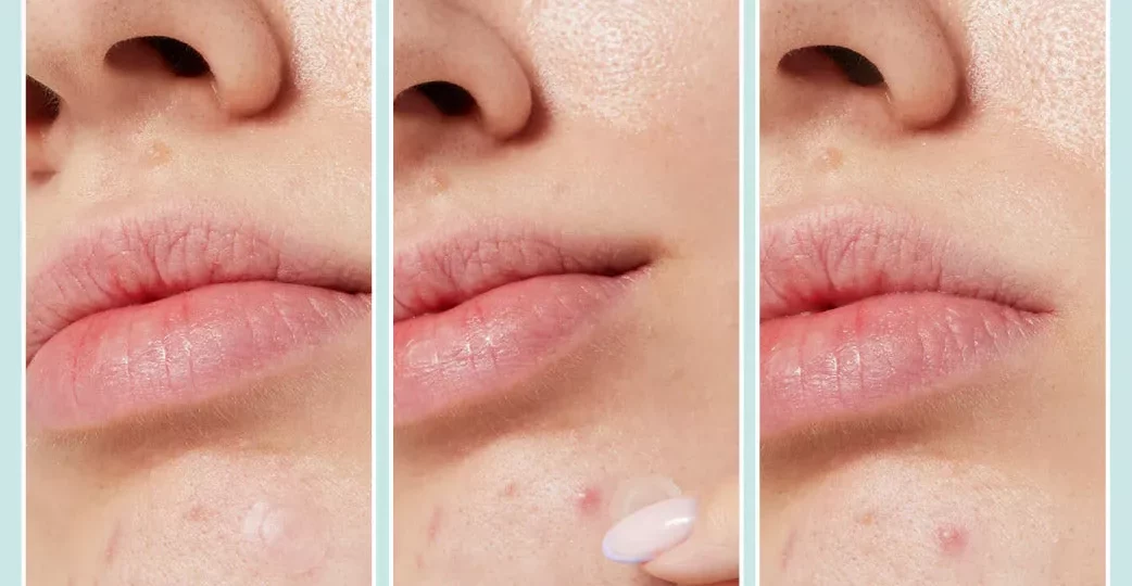 التخلص من البثور السوداء في الأنف بوصفات طبيعية آمنة وفعالة 1 blackheads nose natural remedy