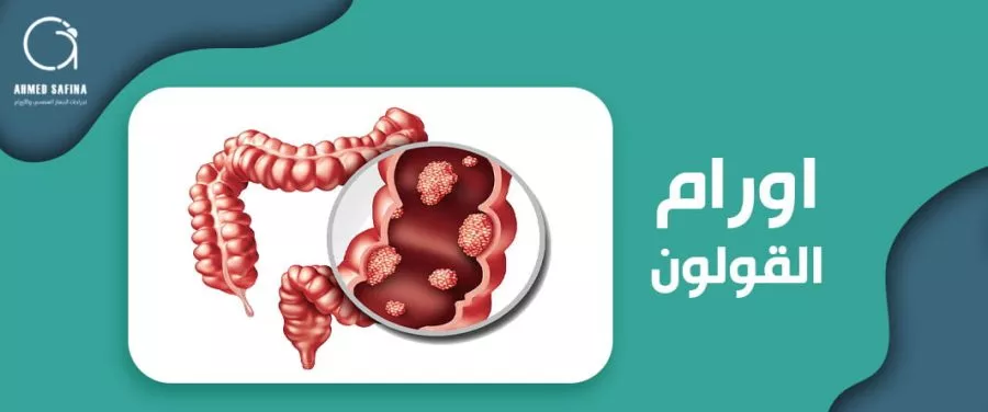 colon cancer awareness illustration