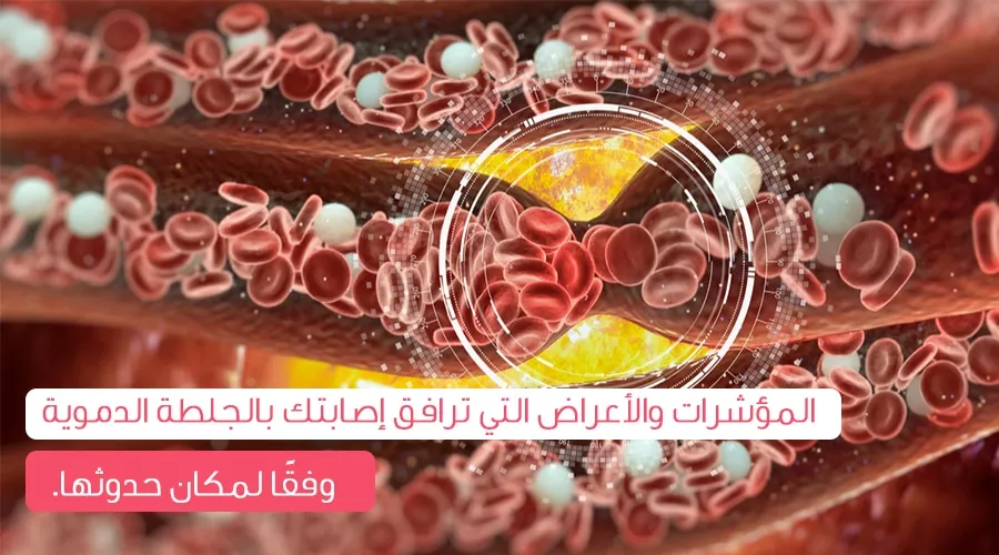 أسباب الجلطة الدموية وطرق الوقاية
