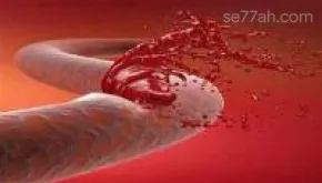 النزيف الداخلي