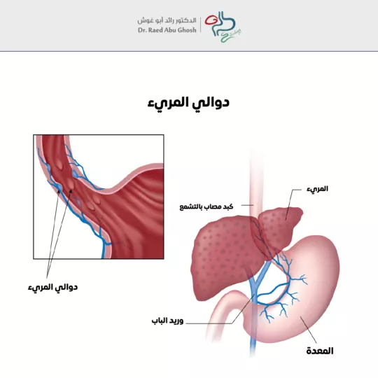 دوالي المريء