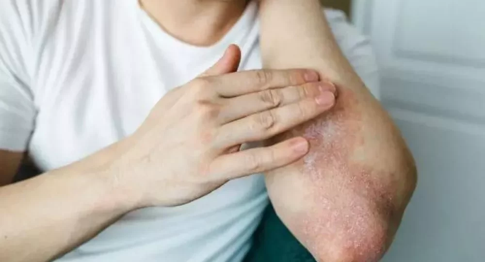 أطعمة تخفف أعراض الصدفية وتدعم صحة الجلد طبيعيًا 1 healthy food for skin inflammation