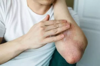 أطعمة تخفف أعراض الصدفية وتدعم صحة الجلد طبيعيًا 2 healthy food for skin inflammation