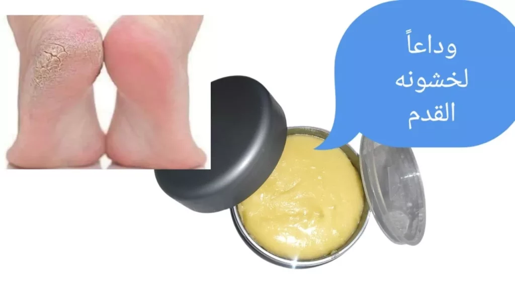 natural foot care cracked heels