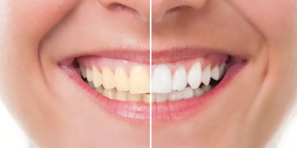 تبييض الأسنان بطرق فعالة وآمنة للتخلص من الاصفرار نهائيًا 1 teeth whitening smile