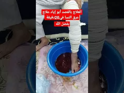 العلاج بالفصد
