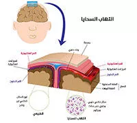 تفشي التهاب السحايا في كينت