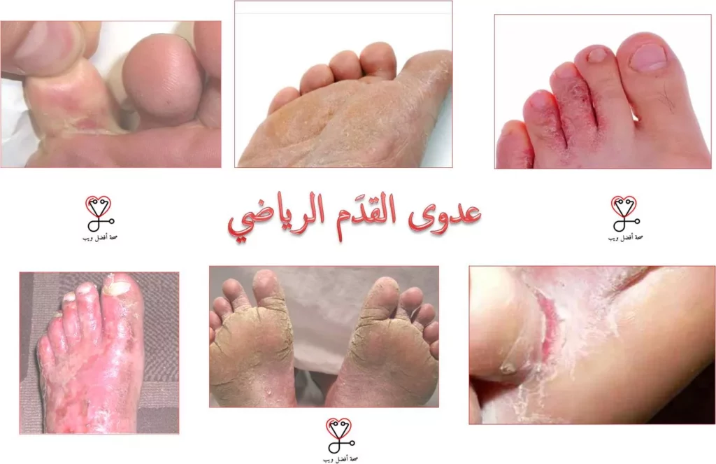 التخلص من فطريات القدم