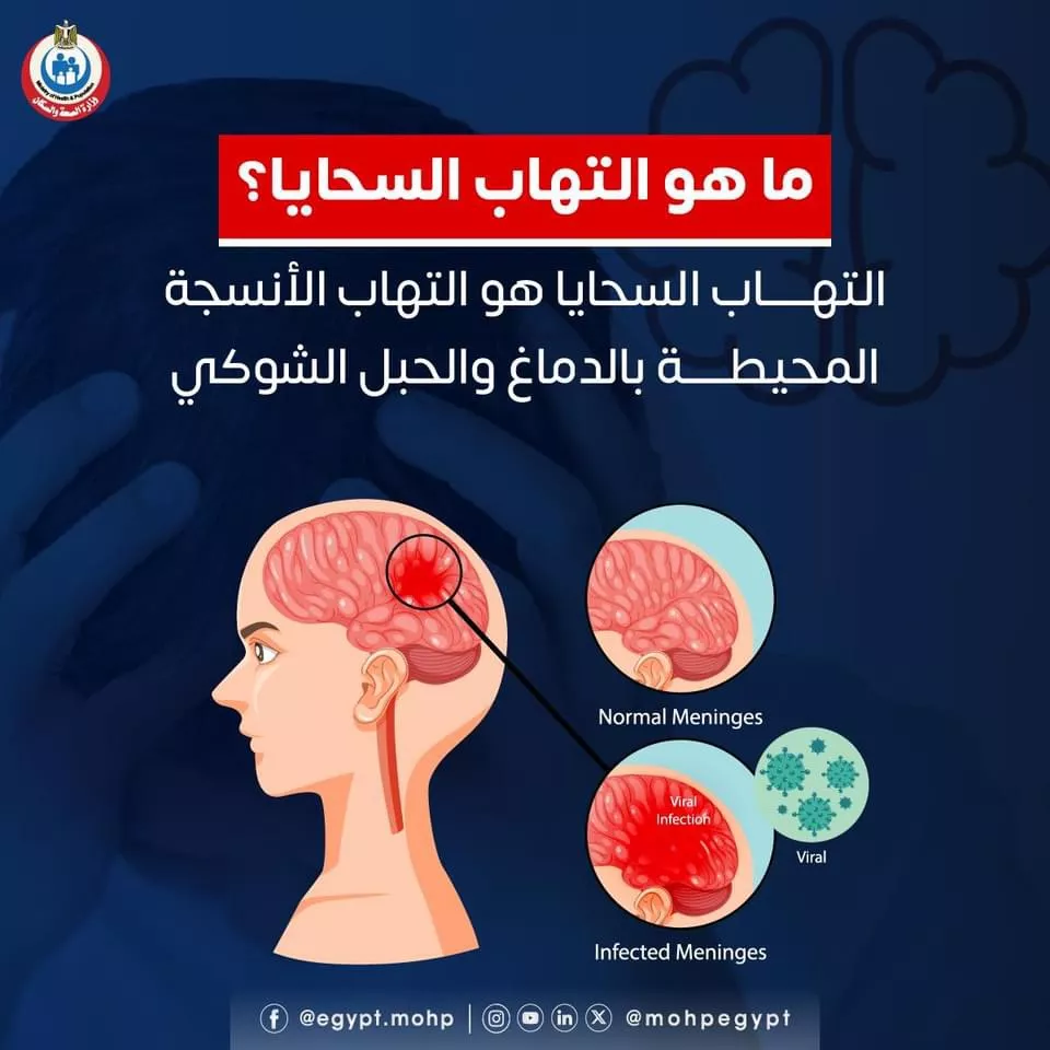 تفشي التهاب السحايا في بريطانيا