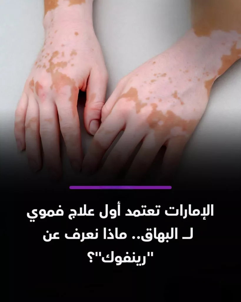 رينفوك لعلاج البهاق